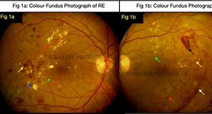 Dot Blot Hemorrhages Adalah